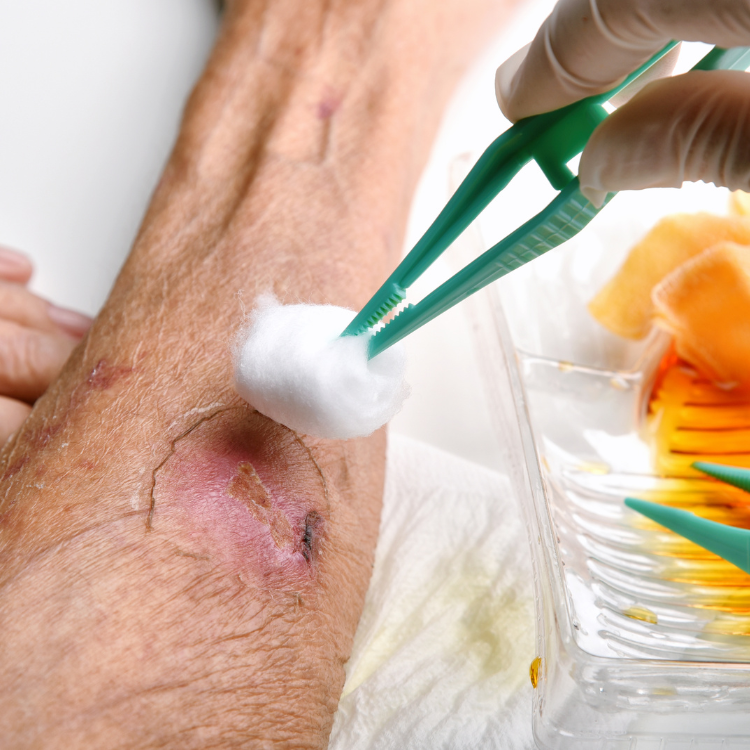 Clinician providing wound care related to diabetic foot ulcers